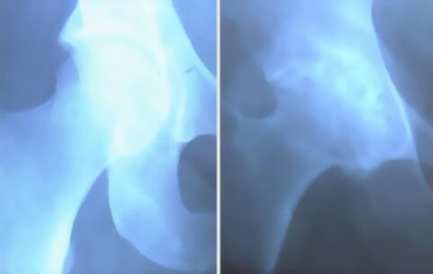 Осадок артрита коленного сустава